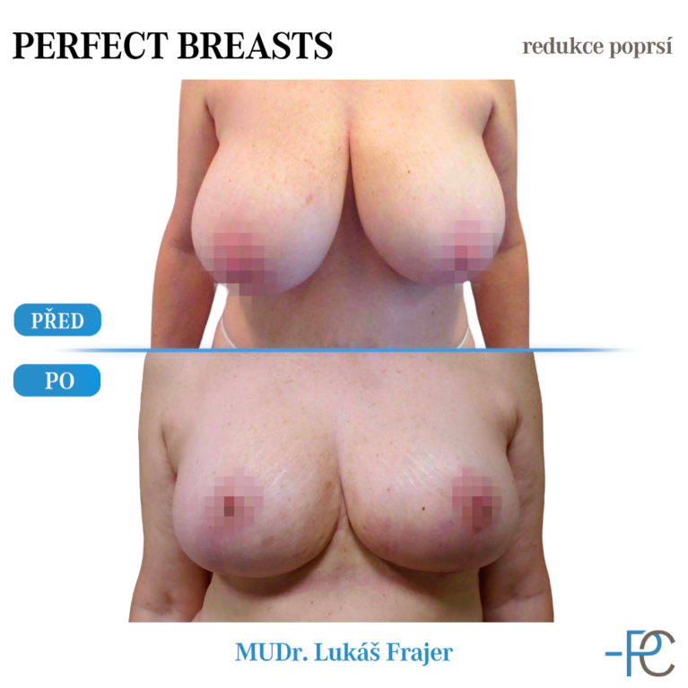 Breast reduction