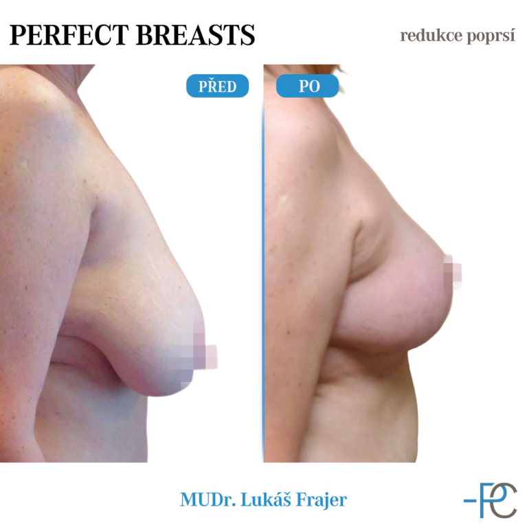 Breast reduction