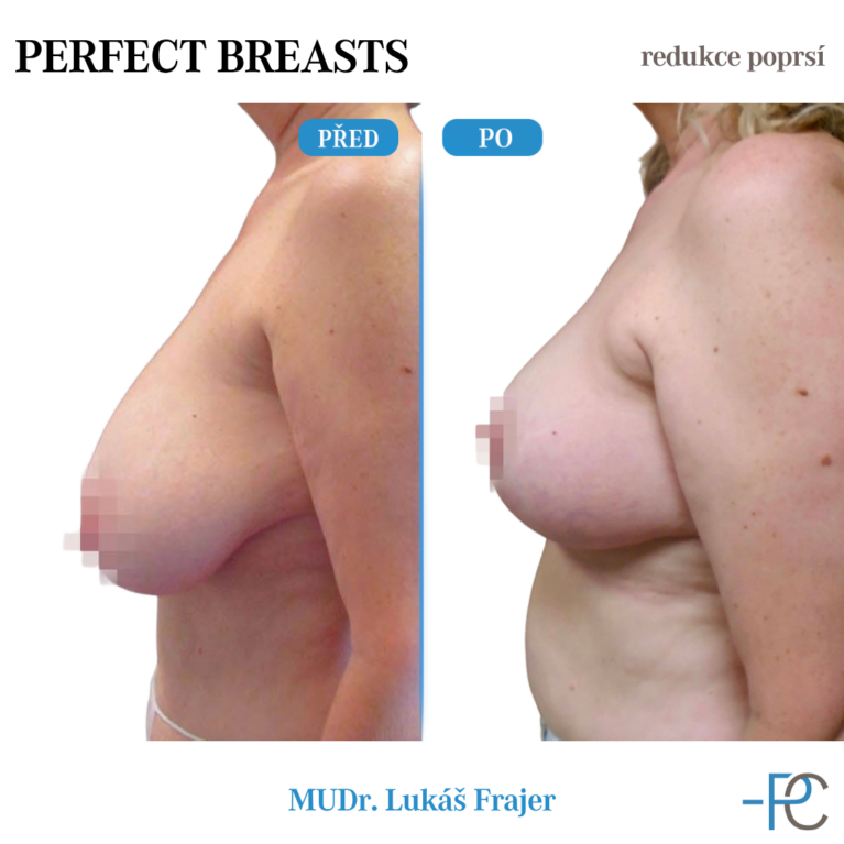 Breast reduction