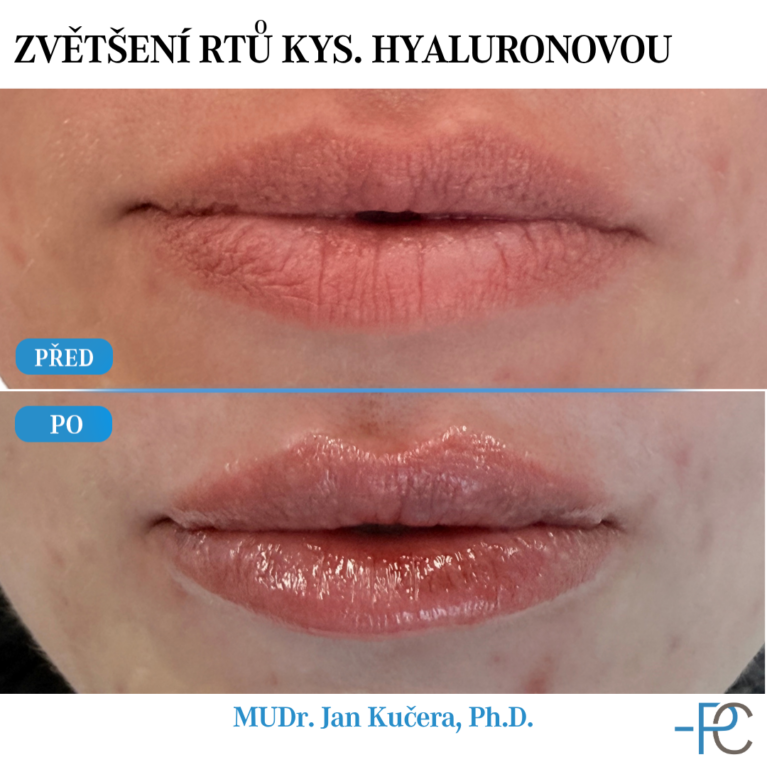 Lip augmentation with hyaluronic acid