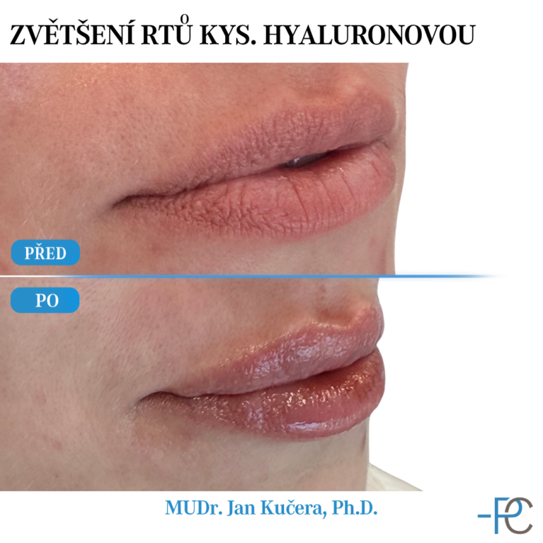 Lip augmentation with hyaluronic acid