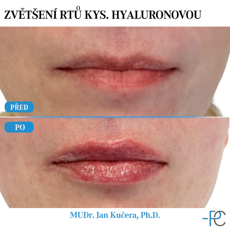 Lip augmentation with hyaluronic acid