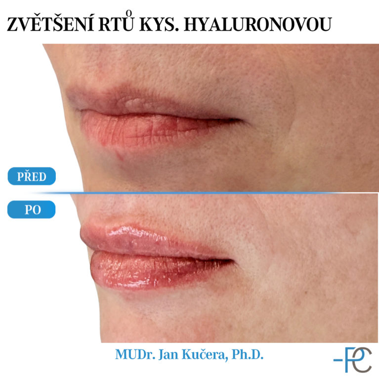 Lip augmentation with hyaluronic acid