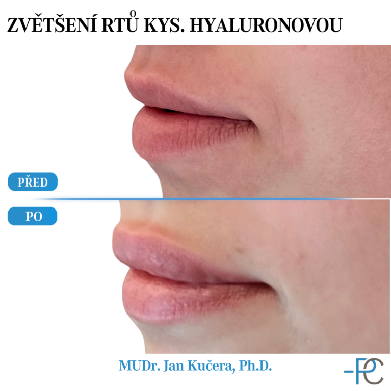 Lip augmentation with hyaluronic acid