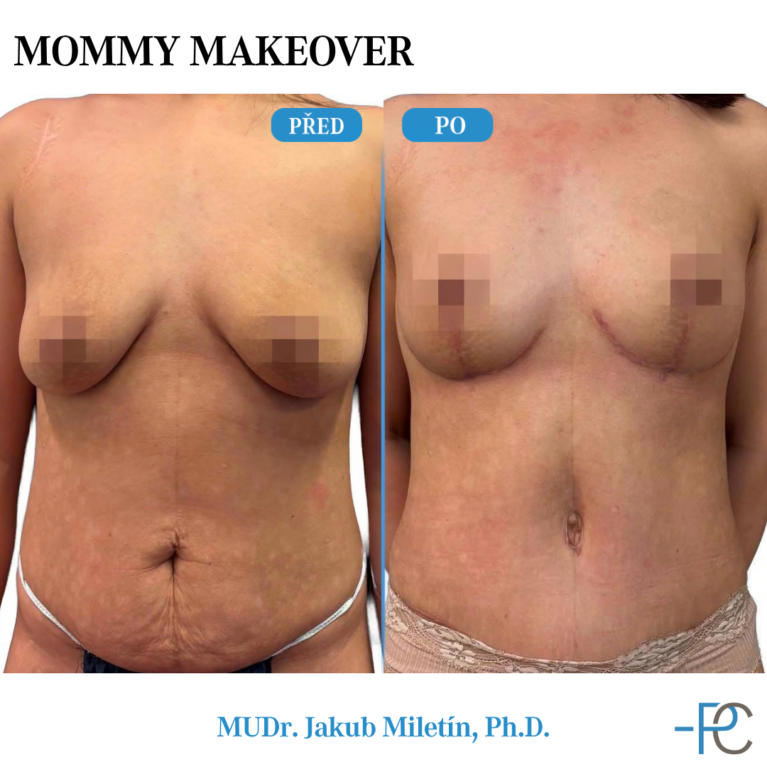 Mommy Makeover