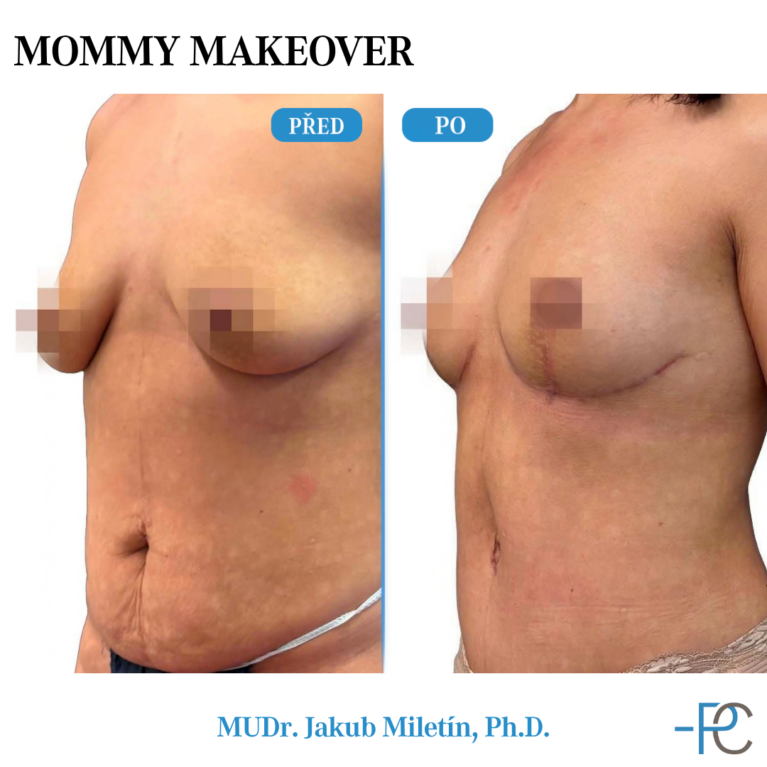 Mommy Makeover