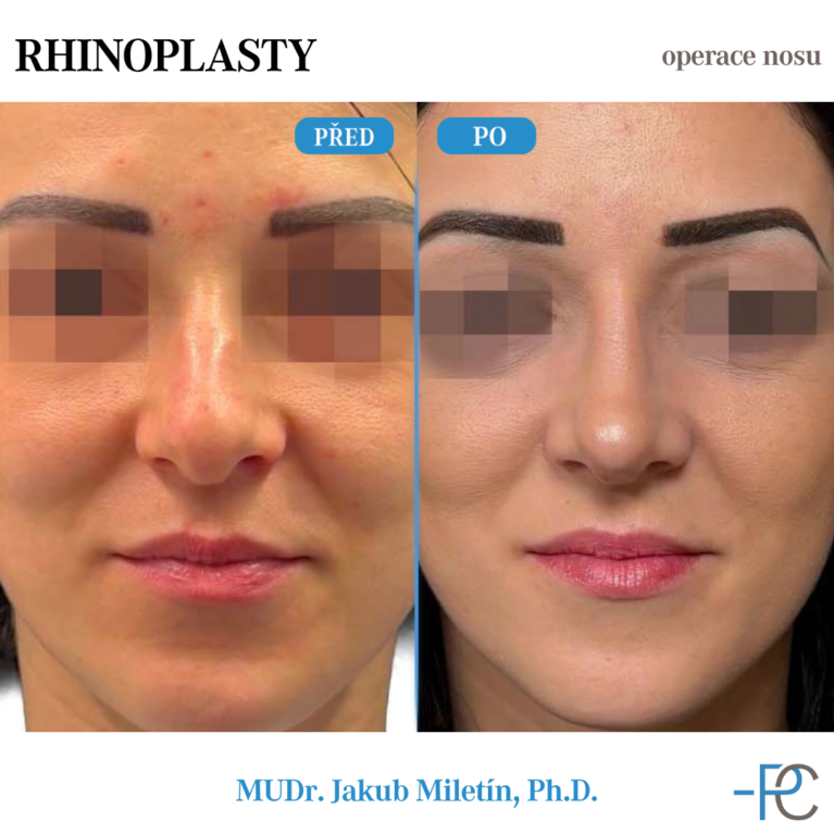 PGA rhinoplasty