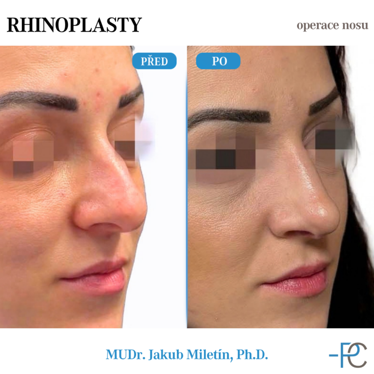 PGA rhinoplasty
