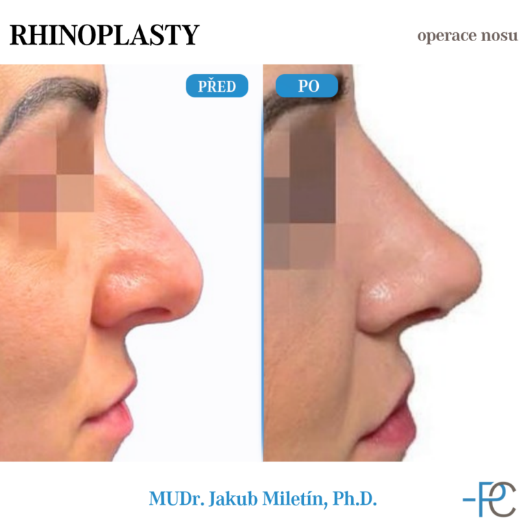 PGA rhinoplasty