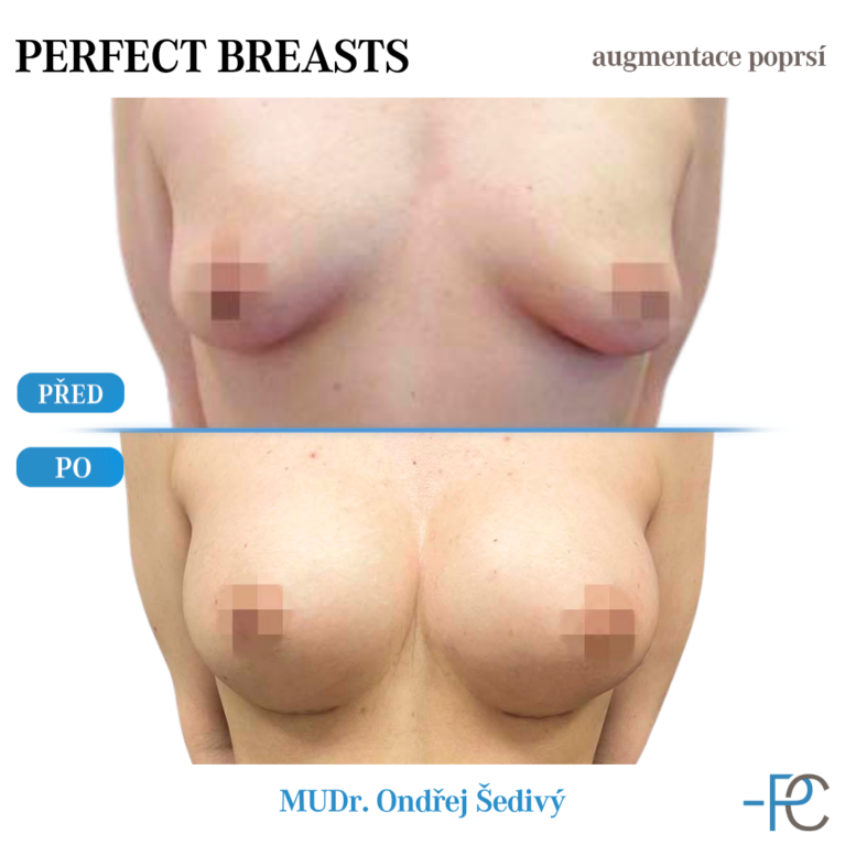 Breast augmentation