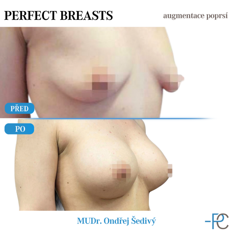 Breast augmentation