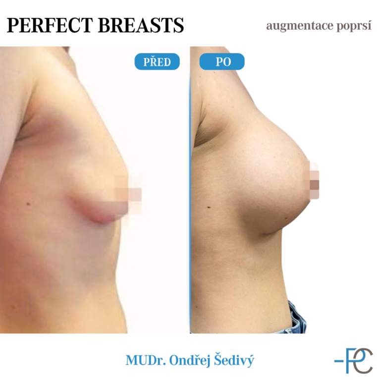Breast augmentation